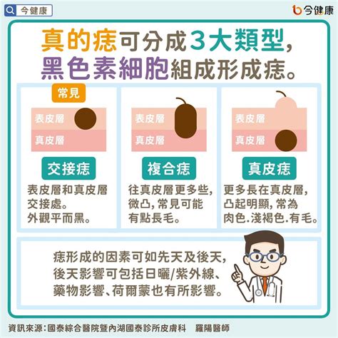 胸部紅色痣|是痣or皮膚癌？醫「1張圖秒對照」 長這2部位最危險